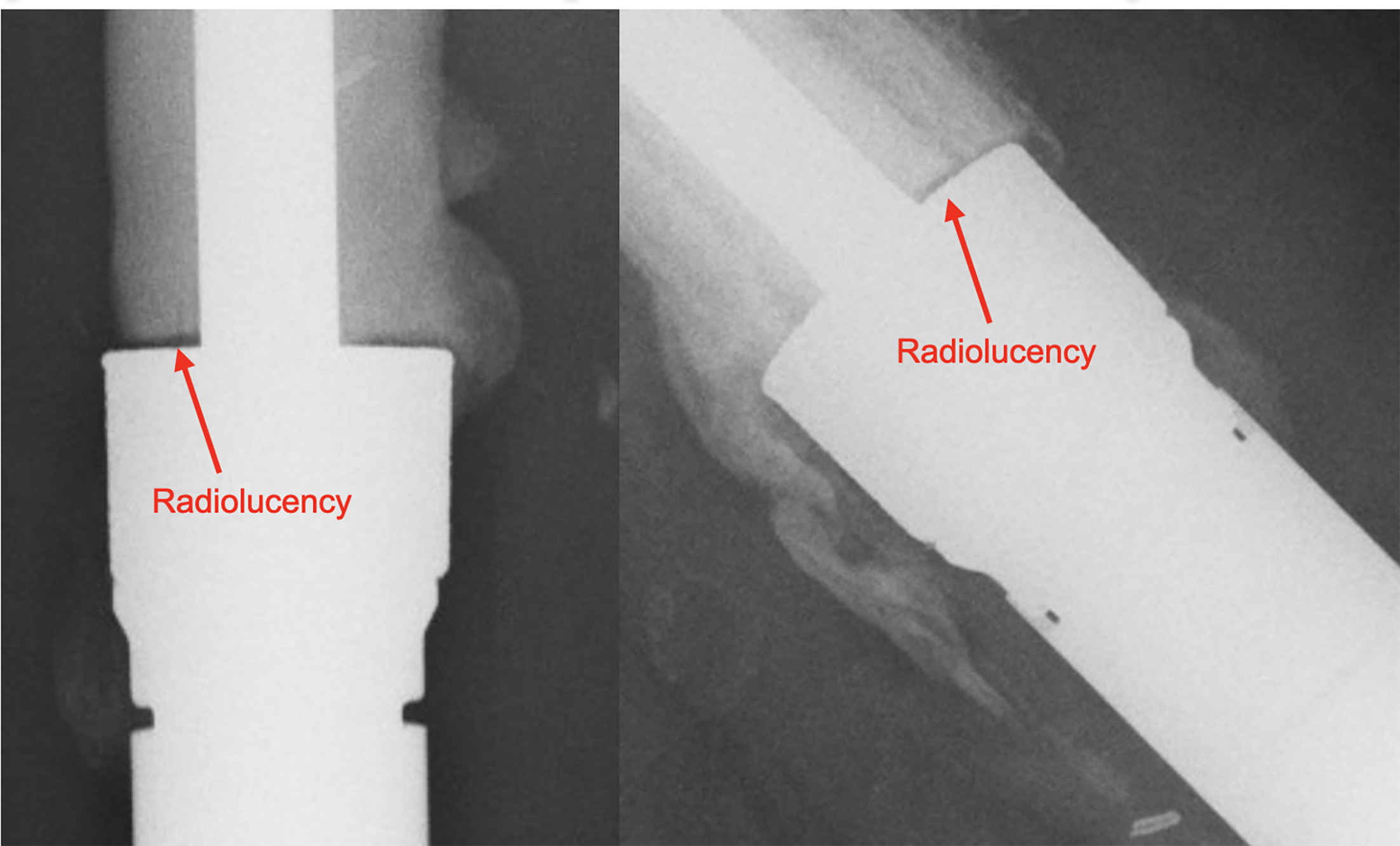 Fig. 2 
            Radiolucent line score: extracortical bone and implant collar in anteroposterior and lateral images.
          