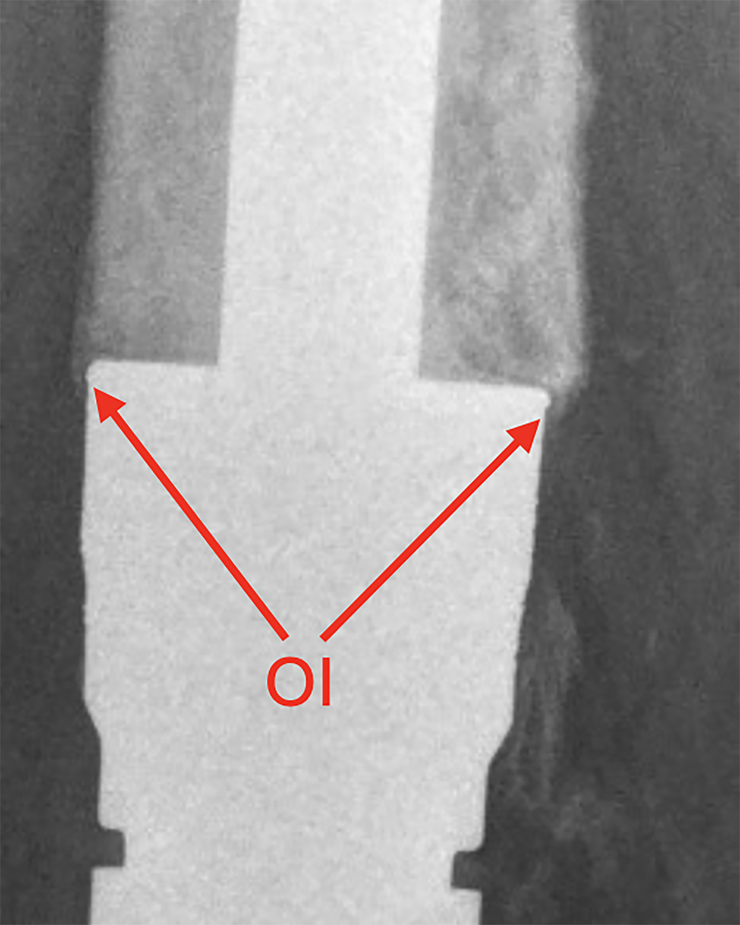 Fig. 4 
            Osseointegration (OI) score.
          