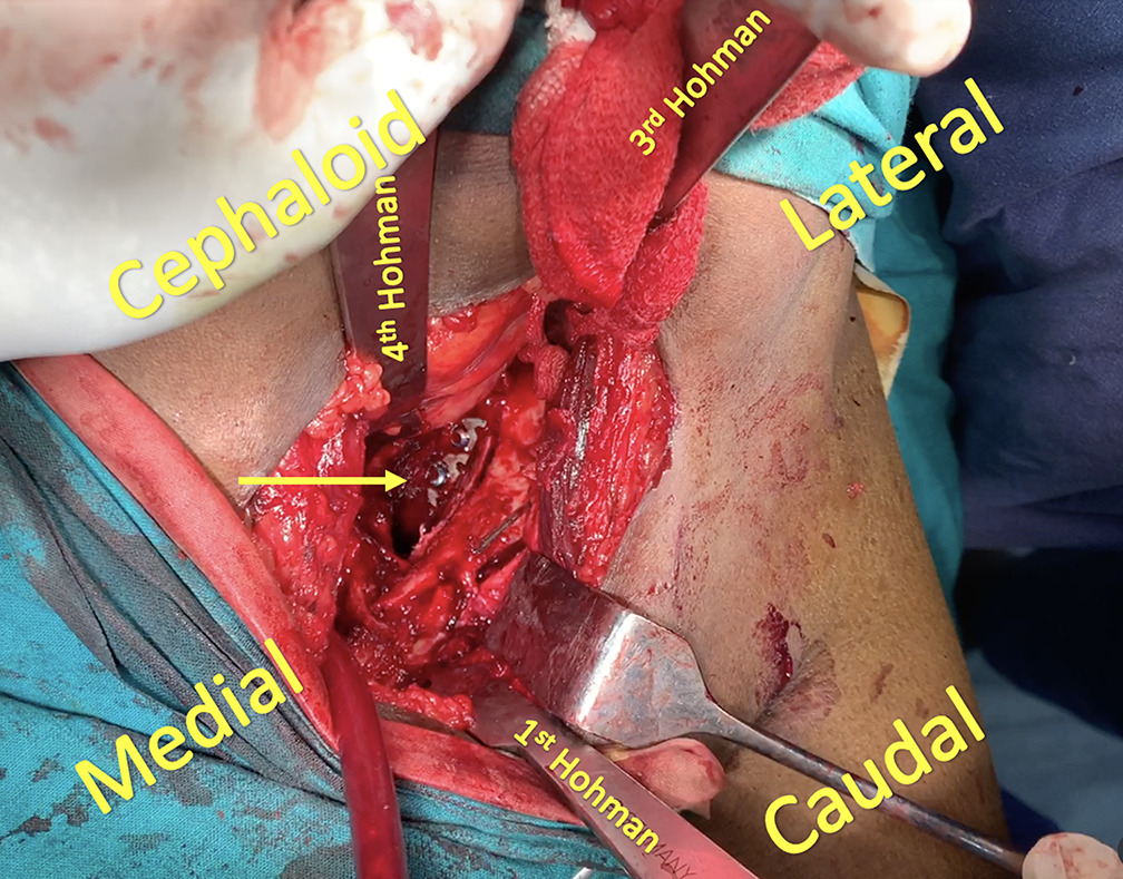 Fig. 3 
            Anterior intrapelvic approach with position of Hohman’s position, as described by Sagi et al.9 Hohman positioned at pubic tubercle third at iliac fossa just lateral to sacroiliac joint, and fourth Hohman at ischial spine. The second Hohman, described by Sagi et al,9 was not placed here. The position of the plate along the medial side of posterior column along the border of sciatic notch is shown (see arrow).
          