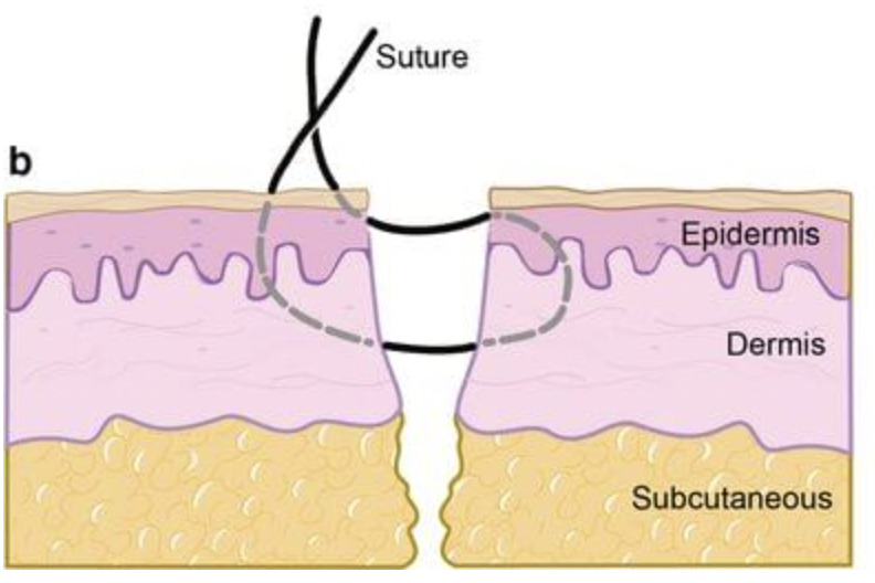 Fig. 2 
            Image demonstrating the Allgöwer-Donati suture technique.
          