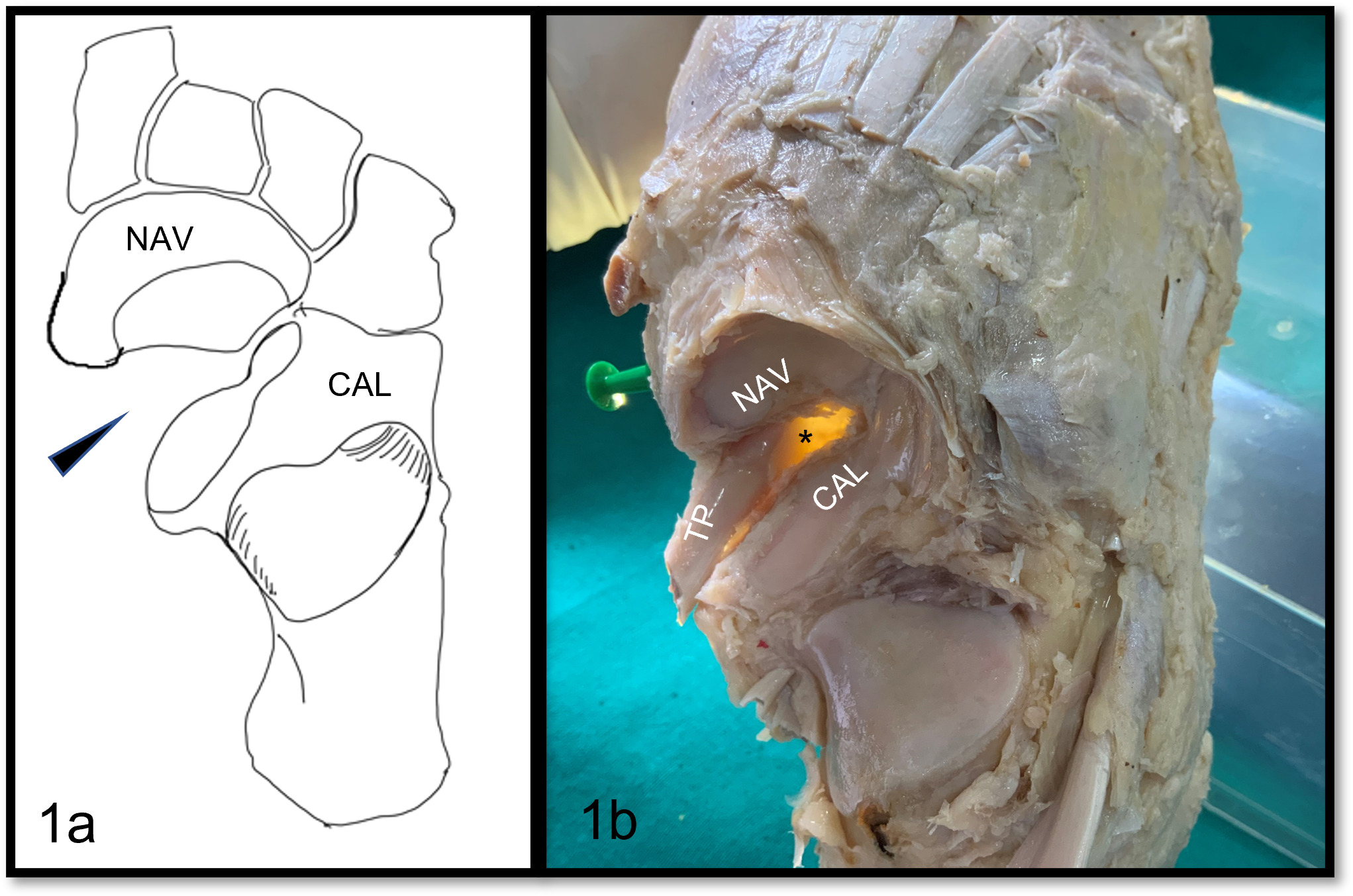 Fig. 1 
            a) Schematic line diagram, and b) photograph of the socket of the talocalcaneonavicular joint after removing the talus. A triangular gap (solid arrow head) between the calcaneus and the navicular bone is seen, which narrows laterally and widens medially; it is also the highest in location. CAL, calcaneocuboid; NAV, navicular, TP, tendon of tibialis posterior.
          