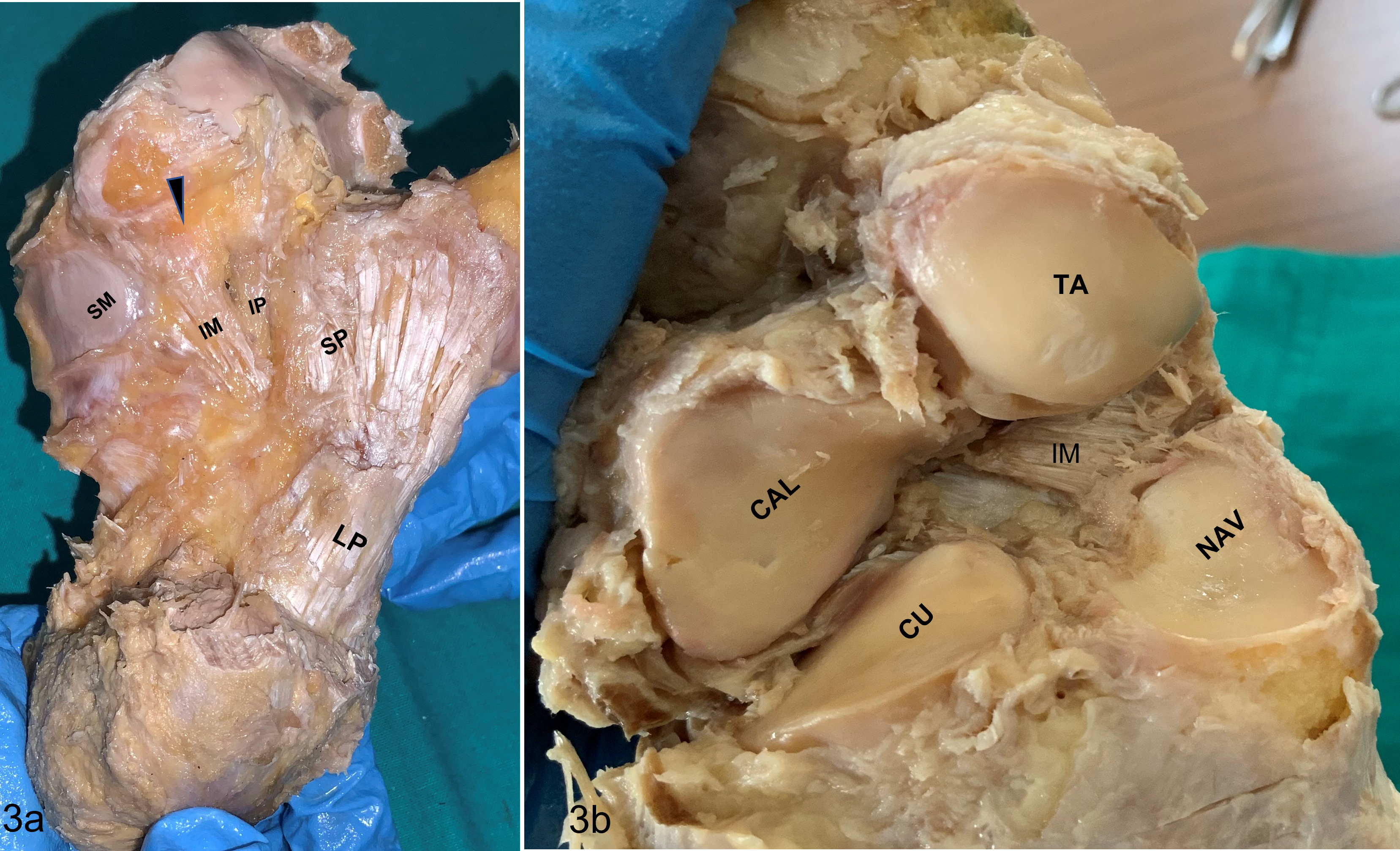 Fig. 3 
            a) Inferior static supports of the Chopart joint. Arrowhead shows the gap between the inferomedial and inferoplanter bundles of the spring ligament. Note the extent of the superomedial bundle of the spring ligament. b) Direction of fibres of inferoplantar bundle when observed from within the joint cavity. CAL, calcaneocuboid; CU, cuboid; IM, inferomedial; IP, inferoplanter; LP, long plantar ligament; NAV, navicular; SM, superomedial; SP, short plantar ligament.
          