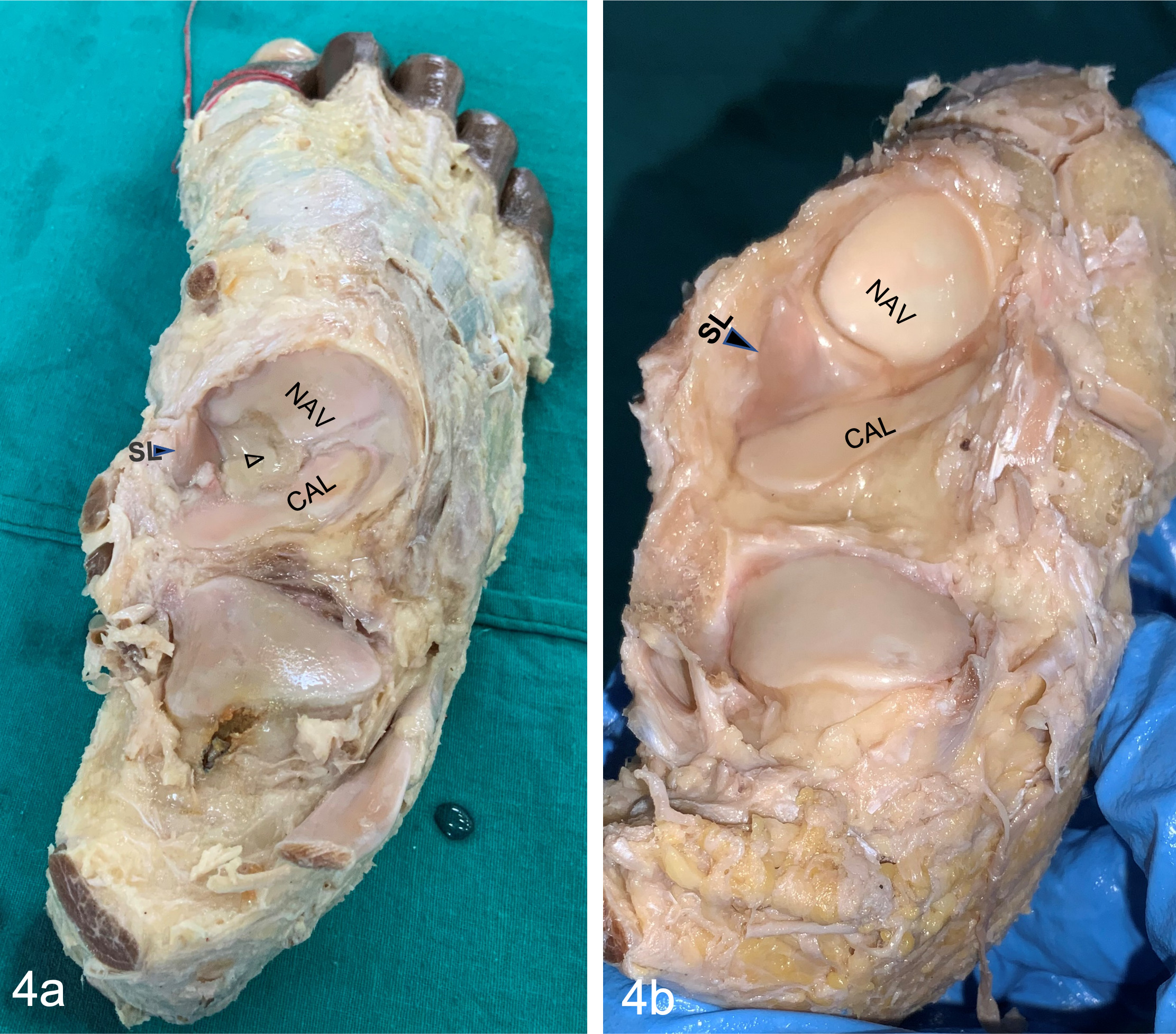 Fig. 4 
            a) Lesser cartilage coverage and more fibrofatty tissue as compared by b) variability in the extent of the cartilage covering the spring ligament and the variable amount of fibrofatty tissue (empty arrowhead) present. The solid arrowhead shows the highest extent of the spring ligament. CAL, calcaneocuboid; NAV, navicular; SL, spring ligament.
          