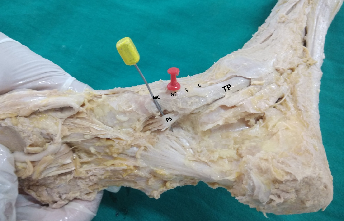 Fig. 6 
            Thick plantar slip (PS) of the tendon of the tibialis posterior coursing into the sole. Arrowheads indicate the other slips of the tibialis posterior, going towards a) navicular and b) medial cuneiform. LP, long plantar ligament; SP, short plantar ligament; TP, tendon of tibialis posterior.
          