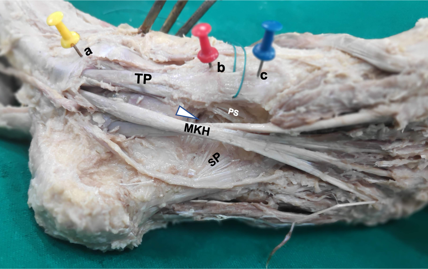 Fig. 8 
            Surface landmarks for localizing the master knot of Henry (MKH). a) tip of medial malleolus, b) navicular tuberosity, and c) medial cuneiform. The plantar slip of the tibialis posterior is also seen. The MKH is positioned just inferior to the gap between the inferoplanter and inferomedial bundles of spring ligament, indicated by the arrowhead. PS, planter slip of the tendon of tibialis posterior; SP, short plantar ligament; TP, tendon of tibialis posterior.
          