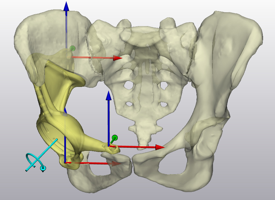 Fig. 4 
            Representation of the studied implant rotation axis (cyan) and implant flanges with corresponding three axis of translation (anteversion and inclination angles and cup centre of rotation not shown).
          