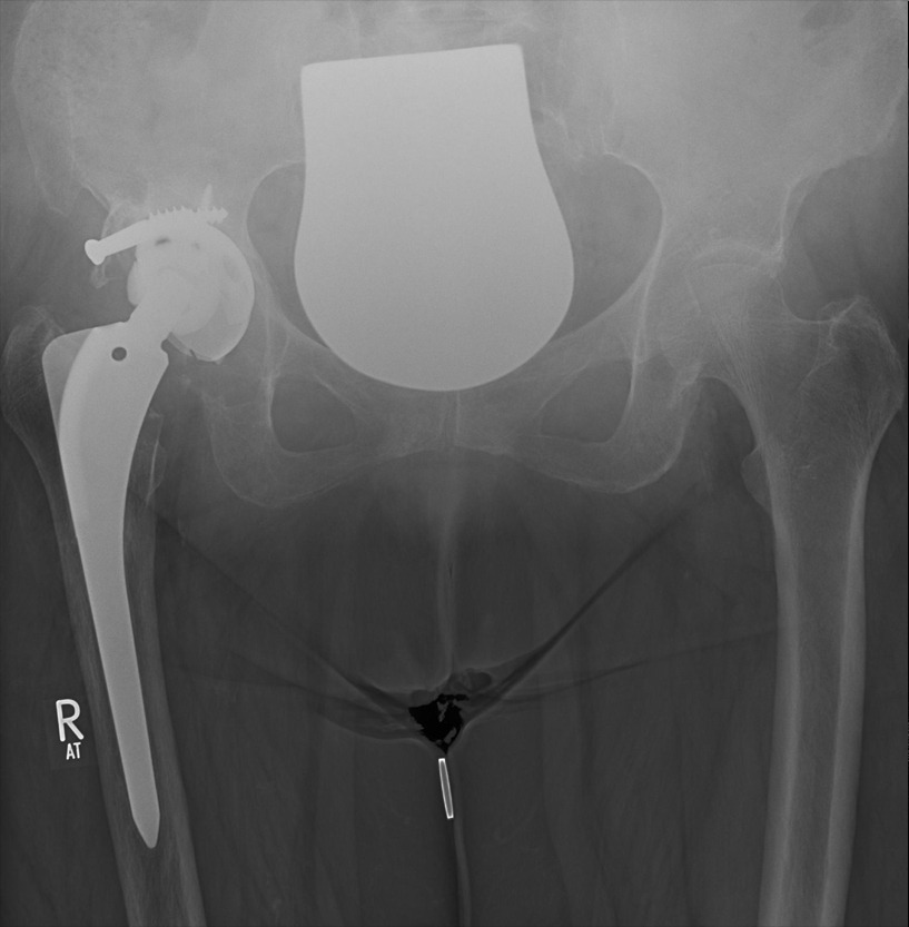 Fig. 1 
            Example case 1: preoperative anteroposterior radiograph showing a Paprosky IIIA defect in a 69-year-old female patient with aseptic component loosening, treated with a one-stage exchange.
          