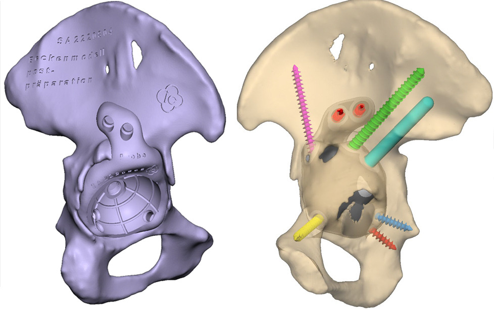 Fig. 2 
            Example case 1: implant and fixation model planning.
          