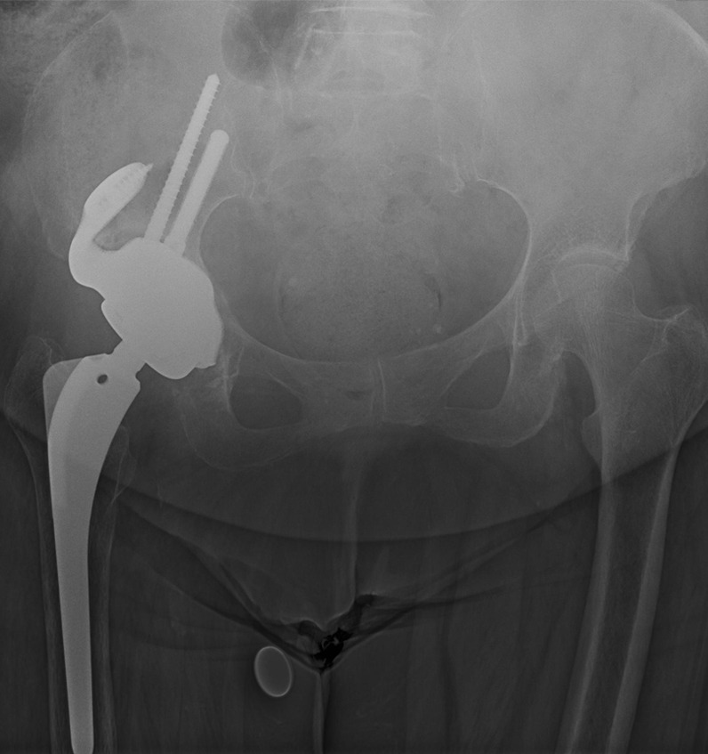 Fig. 3 
            Example case 1: anteroposterior pelvis radiograph at two-year follow-up post-implantation.
          