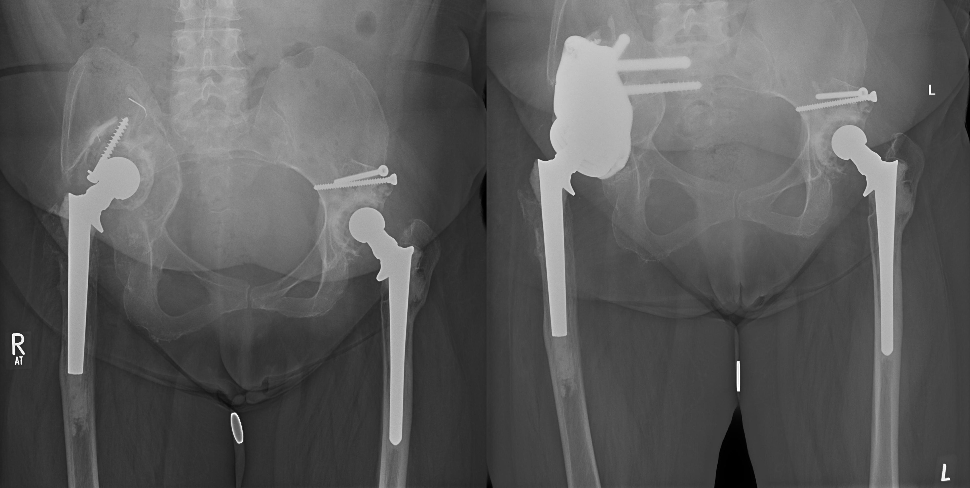 Fig. 4 
            Example case 2: a 65-year-old female patient with an extensive illiacal bone loss due to polyethylene wear after a primary arthroplasty 27 years earlier. The patient was treated with a custom-made implant with iliosacral fixation in a one-stage exchange. Due to insufficient follow-up, the patient was not included in the study.
          