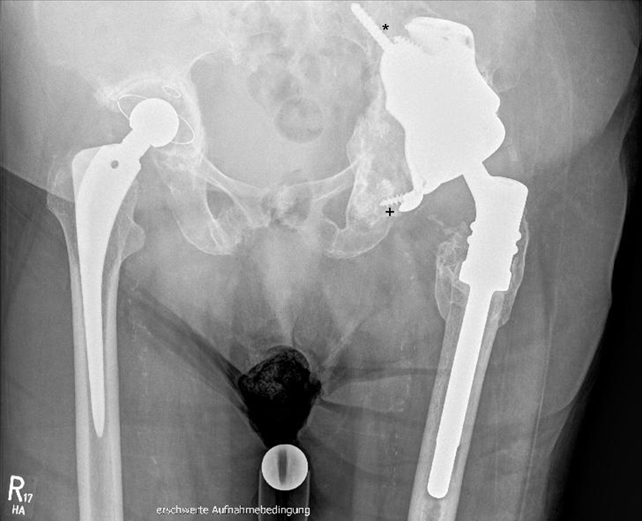 Fig. 6 
            A 79-year-old female patient at seven-year follow-up, treated with a two-stage exchange due to periprosthetic joint infection. * designates the 8 mm screw for primary stability. + designates the small inferior flanges which were used in the first designs as, well as the inferior fixation which is no longer conducted regularly but remains an option.
          