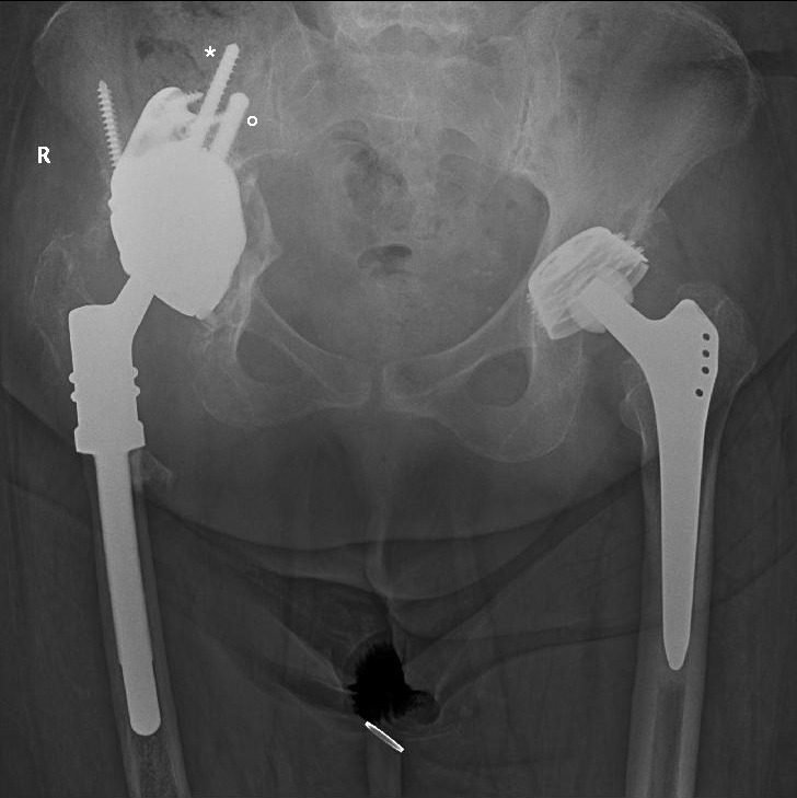 Fig. 7 
            A 68-year-old female patient at one-year follow-up, who presented with a girdlestone due to a polybacterial periprosthetic joint infection, treated with a two-stage exchange. * designates the 8 mm screw which is still used in all cases. ° designates the 9 mm highly porous stem which was added later on.
          