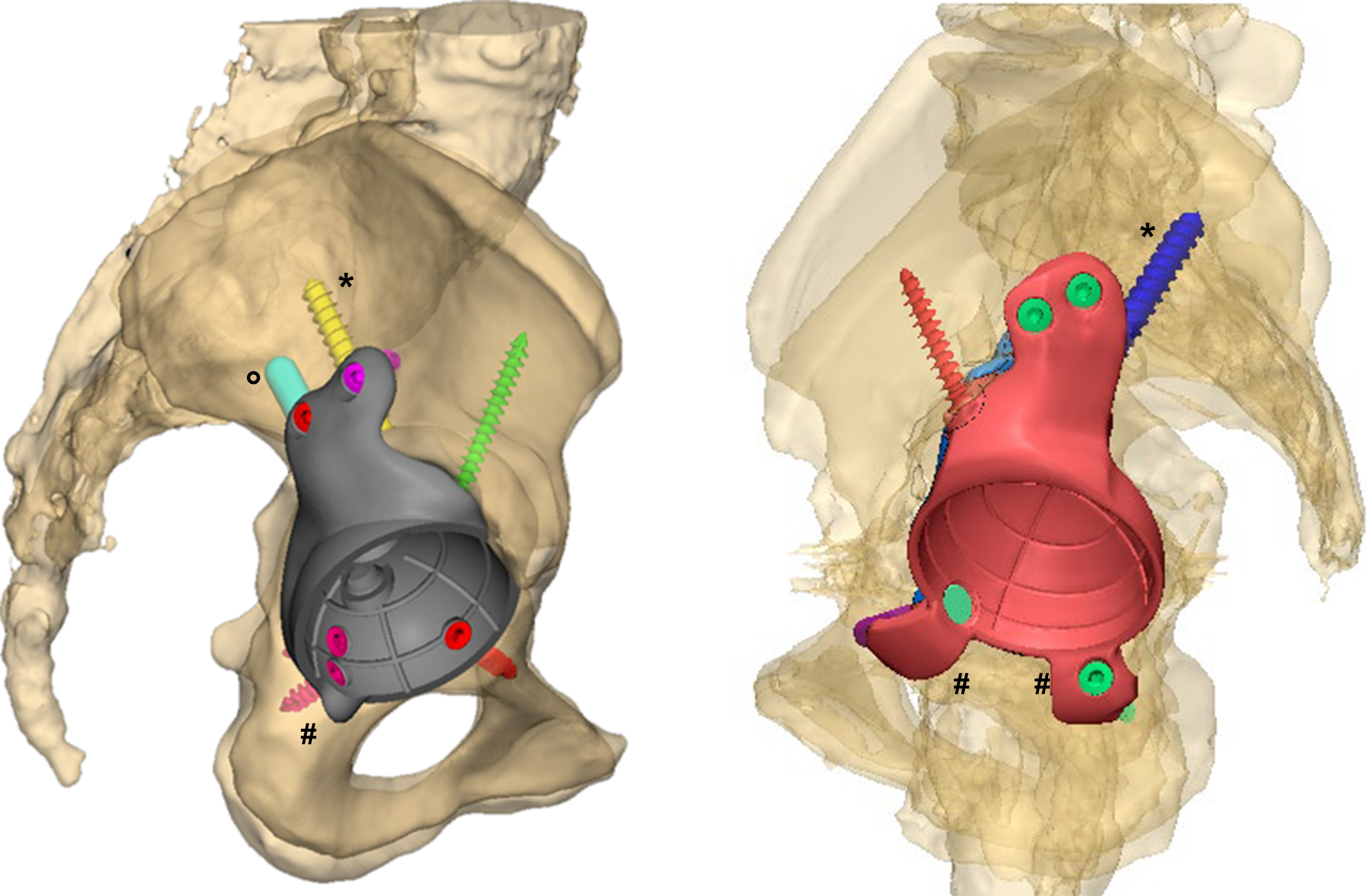 Fig. 8 
            Implant models for the cases present in Figure 6 and Figure 7. * designates the 8 mm screw. ° designates the 9 mm stem. The small flanges used in the first designs are seen on the left side; later on, only small bulges were used, as seen on the right side (all designated by #).
          