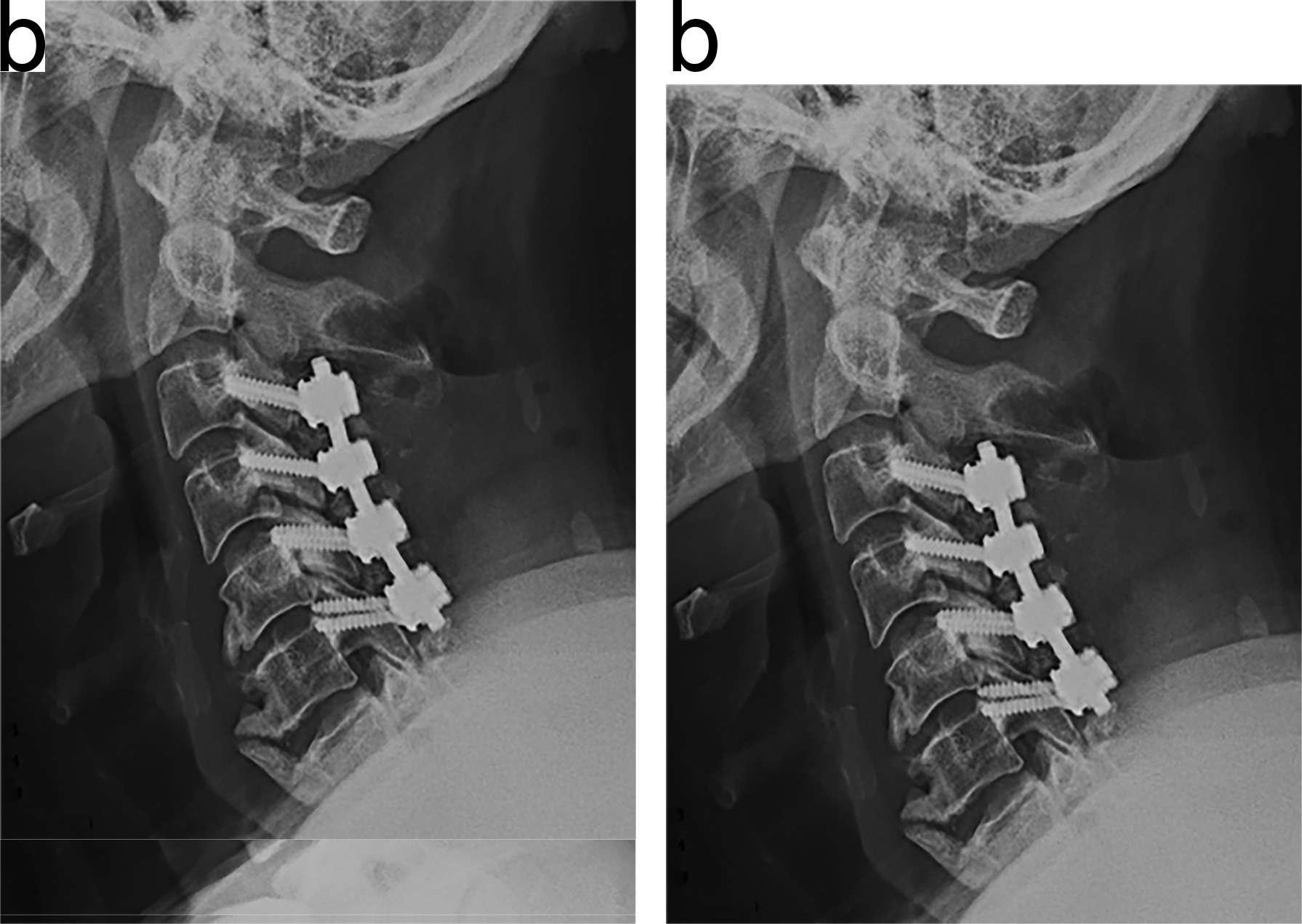 Fig. 3 
            Lateral radiographs after a) anterior decompression with fusion (49-year-old male two days postoperatively) and b) posterior laminectomy with fusion (47-year-old male two days postoperatively).
          