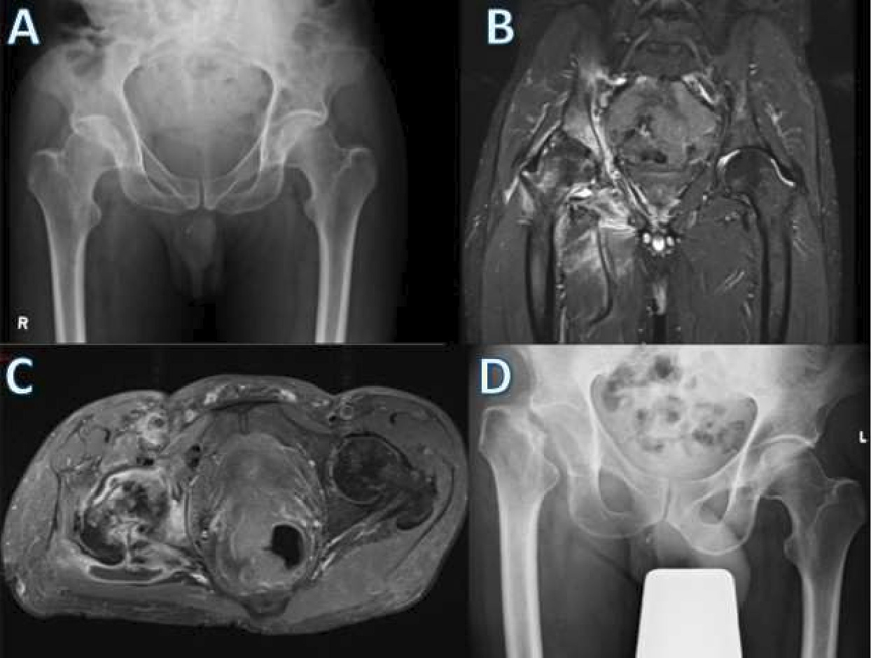 Fig. 2 
            Sequalae of hip sepsis example. a) Initial (total anteroposterior (AP)) pelvis radiograph of 49-year old female at presentation. b) Coronal slice and axial slice. c) Taken from an MRI performed at the same time, demonstrating signal change in the right femoral head indicating bone involvement. d) Postoperative AP radiograph following an excision arthroplasty performed to control the infection.
          