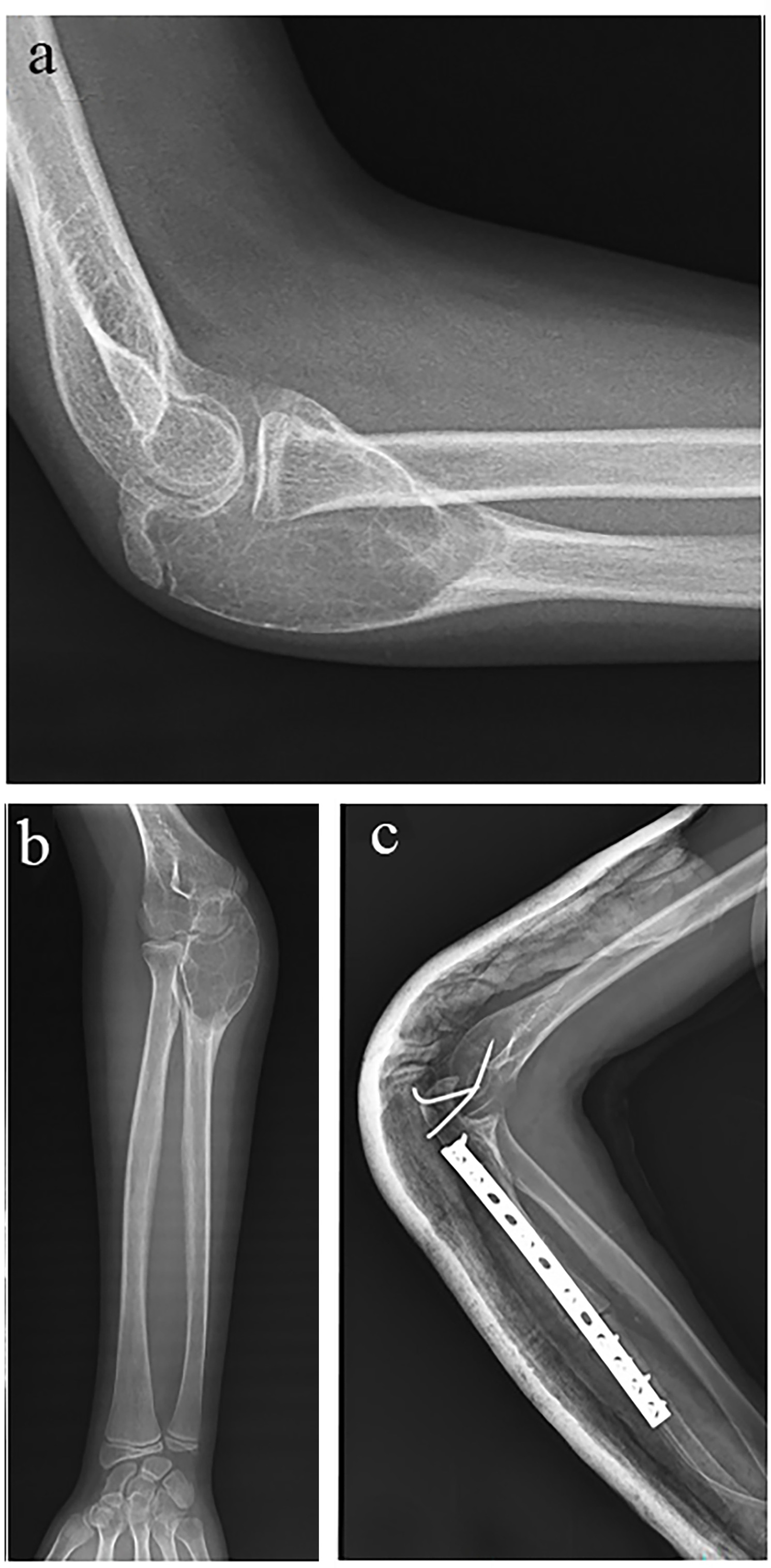 Fig. 2 
            a) Preoperative lateral and b) anteroposterior elbow radiograps of an 11-year-old female with proximal ulna telangiectatic osteosarcoma. c) Postoperative lateral radiograph of the same patient immediately after the operation.
          