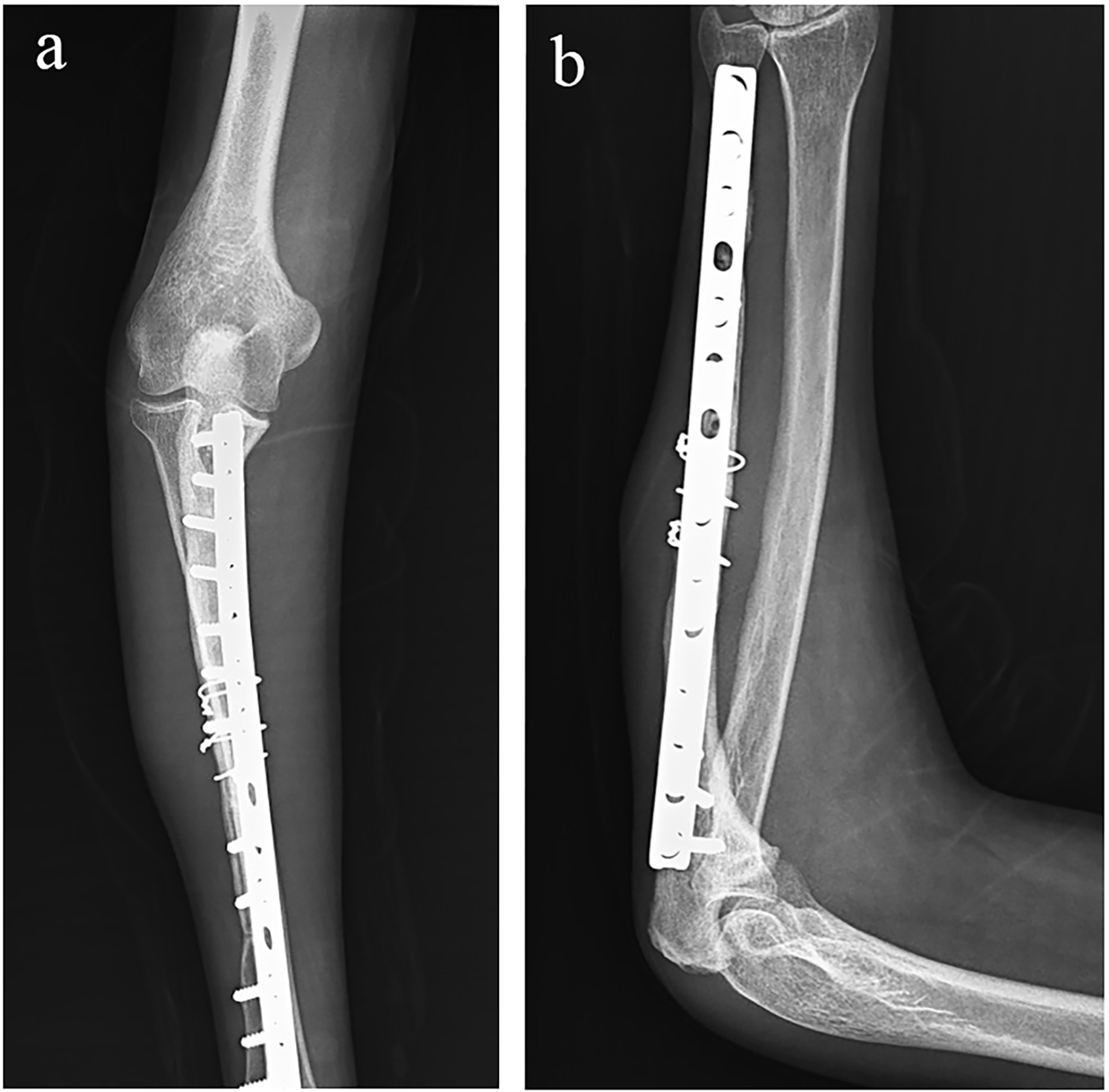 Fig. 5 
            Three-year follow-up radiographs of a 17-year-old female showing infection and allograft fracture after osteoarticular reconstruction of the elbow that was treated with repeated debridement and pelvic autograft fixed with wire.
          