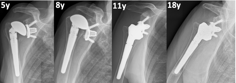 Fig. 3 
            Anteroposterior radiograph views showing a 70-year old female patient who had a traumatic rotator cuff rupture after eight years and underwent conversion to reverse shoulder arthroplasty maintaining the original convertible metal-backed glenoid. After 18 years from the first surgery, the implant is still stable.
          