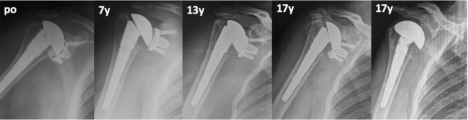 Fig. 4 
            Anteroposterior radiograph views showing a 34-year-old female patient who developed progressive polyethylene eccentric wear with rotator cuff insufficiency noticed at 13 years' follow-up. Conversion to reverse shoulder arthroplasty (RSA) was initially delayed for personal reasons. After 17 years, metal-to-metal contact led to erosion of metal back with severe osteolysis, metallosis with opacification of the periprosthetic soft-tissue (bubble sign48 and loosening). Conversion to RSA was not possible, so removal of the baseplate and conversion to hemiarthroplasty was performed. po, postooperative.
          