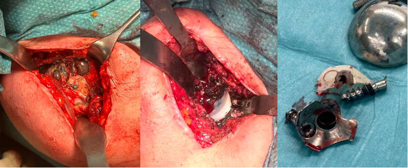 Fig. 5 
            Intraoperative picture of the same case shown in Figure 4. Note the severe eccentric wear of the polyethylene and the metal-backed glenoid, which led to severe metallosis in the surrounding soft-tissue and progressive glenoid loosening.
          