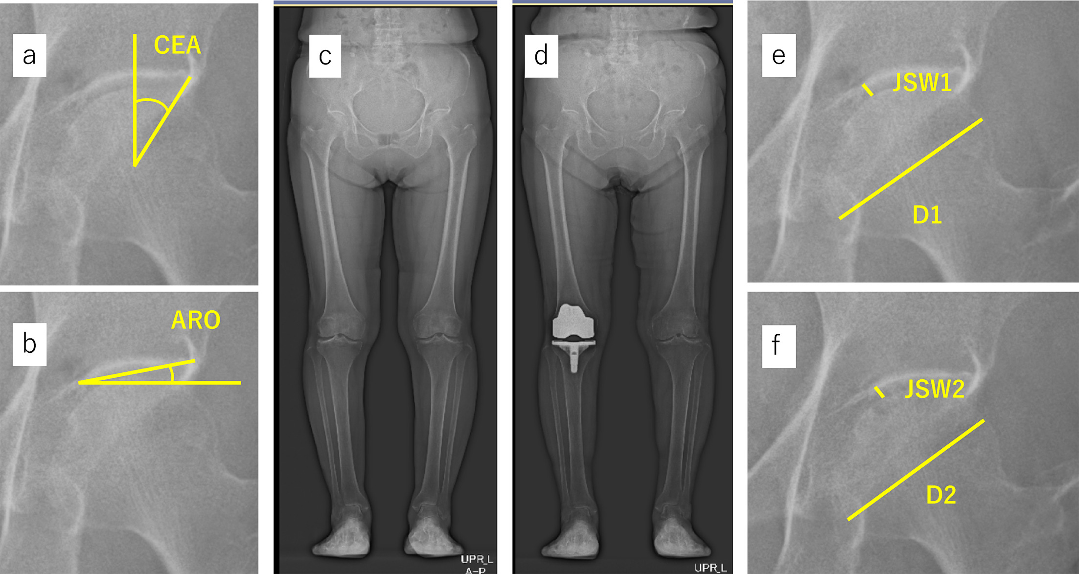 Fig. 2 
            Measurements of the a) centre-edge angle (CEA), b) acetabular roof obliquity (ARO), and hip joint space width (JSW) in a representative case (75-year-old female). c) Anteroposterior (AP) standing whole-leg radiograph taken before surgery. d) AP standing whole-leg radiograph taken five years after surgery. e) Magnified image of the area including the right hip in panel c). f) Magnified image of the area including the right hip in panel d). The JSW and the femoral head diameter were measured as indicated by the yellow lines. JSW1 and JSW2 are the JSWs before surgery and at the final follow-up, respectively. D1 and D2 are the femoral head diameters measured on radiographs at three months after surgery and at the final follow-up, respectively.
          