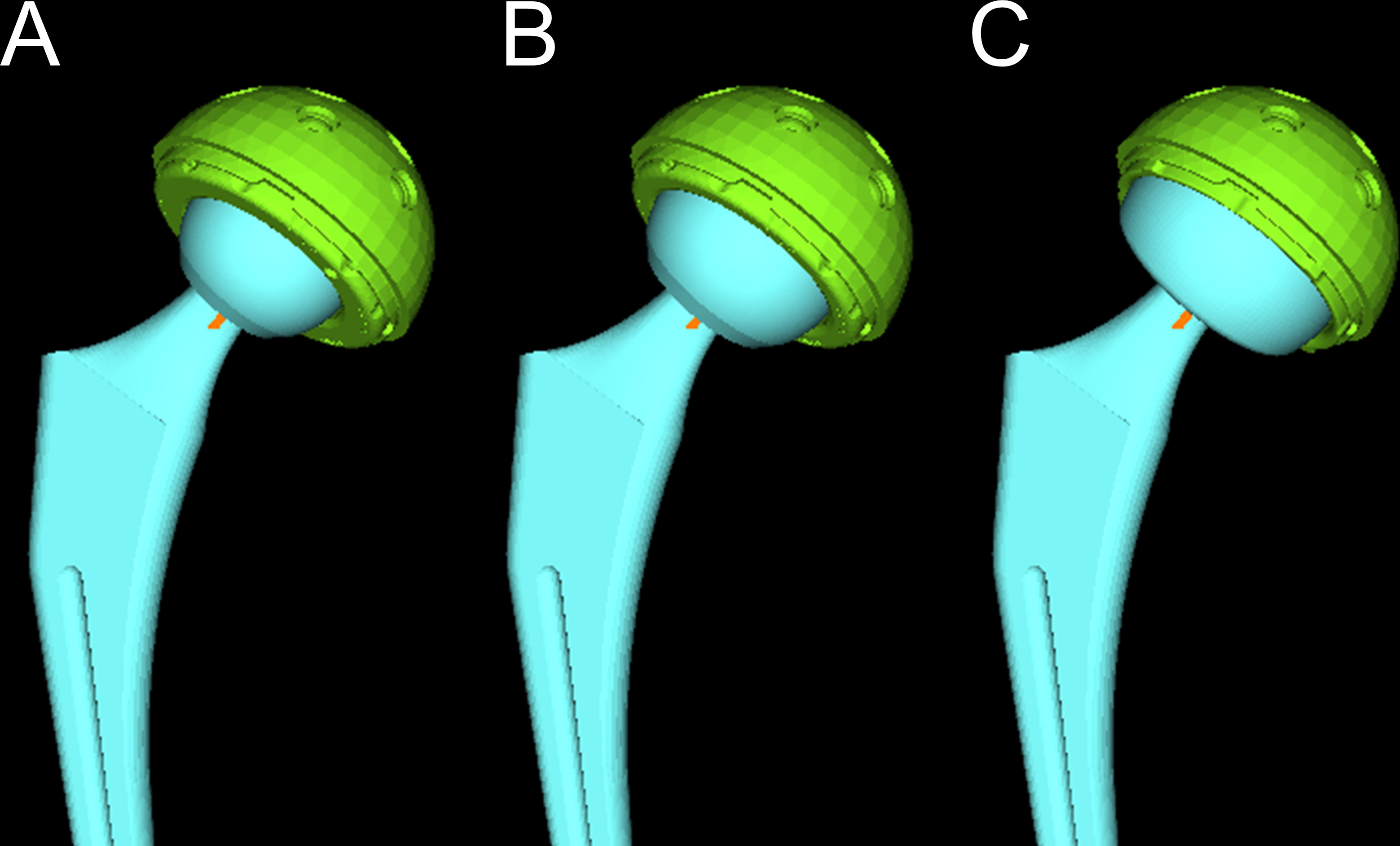 Fig. 3 
            Simulation with the implant is changed to a 36 mm ball and dual-mobility liner, without changing the cup diameter and placement position. a) 32 mm ball, b) 36 mm ball, and c) dual-mobility liner.
          