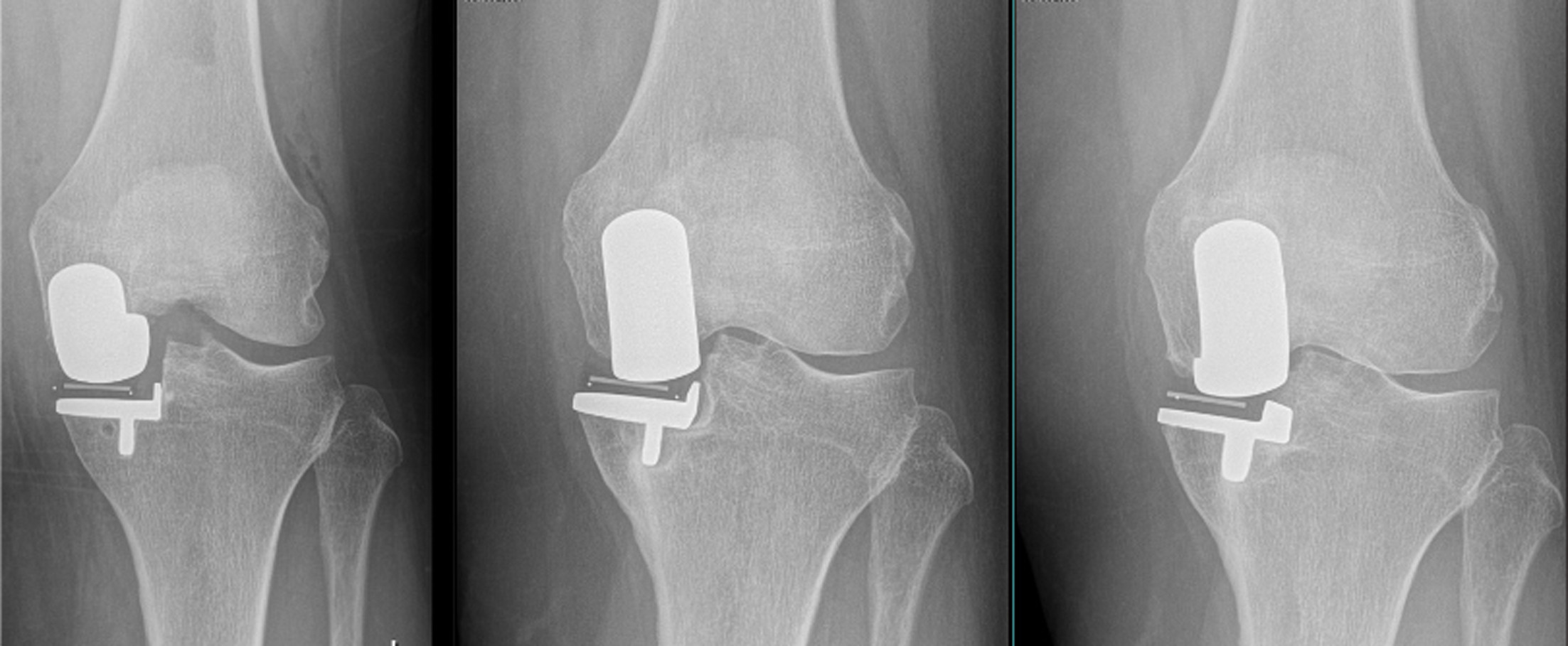 Fig. 1 
          Example of a 53-year-old female patient exhibiting valgus subsidence shown on an anteroposterior radiograph at one day, four weeks, and one year postoperative.
        