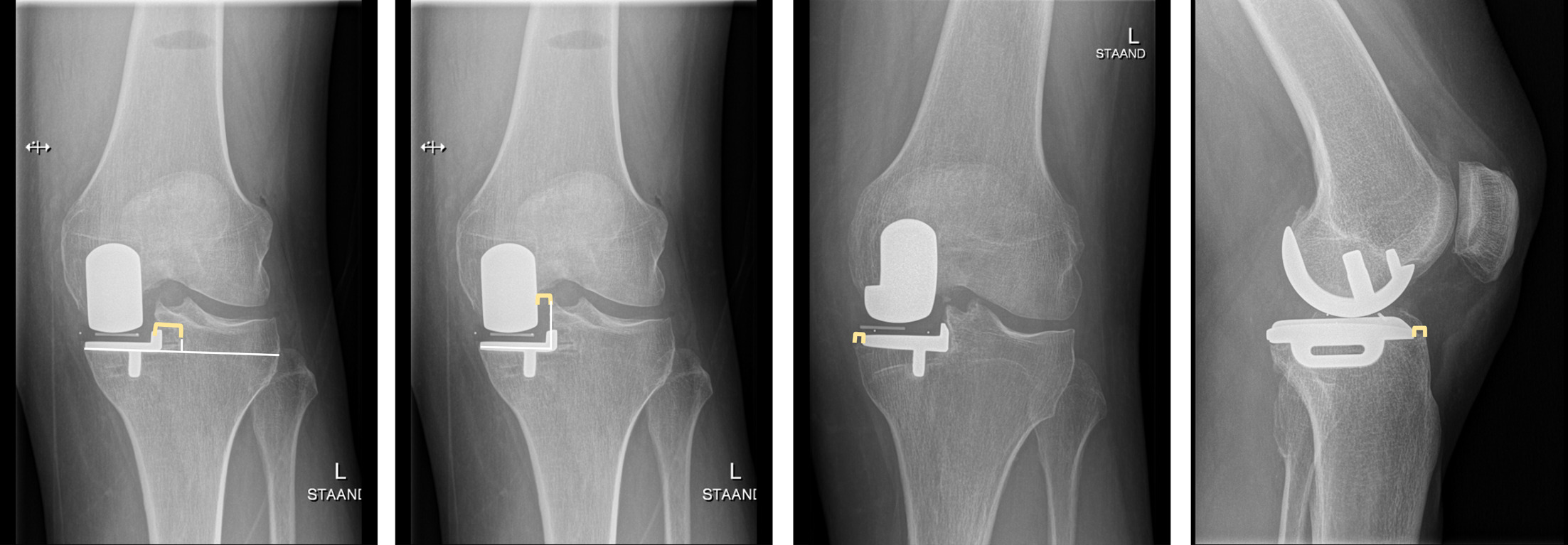 Fig. 2 
            An overview of measurements not described in literature: the first radiograph shows the mediolateral distance of the lateral side of the tibial component to the mediolateral centre of the tibial plateau, measured parallel to the line tangential to the under surface of the tibial component. The second radiograph shows the mediolateral distance between the lateral side of the femoral component and the lateral side of the tibial component, measured parallel to the line tangential to the under surface of the tibial component. The third radiograph shows the mediolateral distance between the medial side of the tibial component and the medial side of the native tibia (medial part of the tibia not covered by the tibial component). The fourth radiograph shows the anteroposterior distance between the anterior side of the tibial component and the anterior side of the native medial tibia (anterior part of the tibia not covered by the tibial component).
          