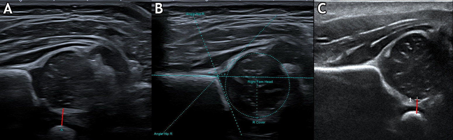 Fig. 1 
            Ultrasound images of three newborn hips as performed by a) and b) a radiologist and c) a midwife. a) and c) depict the pubofemoral distance (PFD) method with PFD marked as a red line, while b) depicts the Graf and Harcke method with annotated α angles and femoral head coverage (FHC).
          