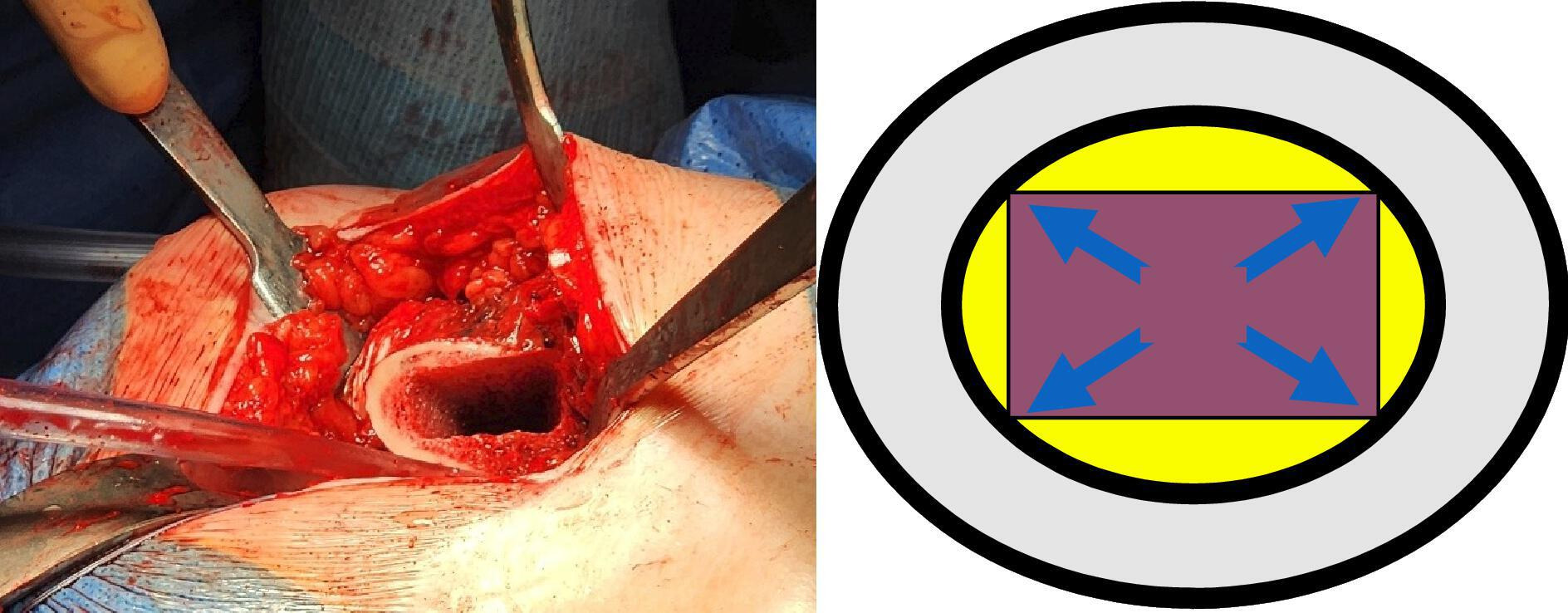 Fig. 4 
          Intraoperative photograph and accompanying diagram showing the rectangular track at the end of femoral broaching.
        